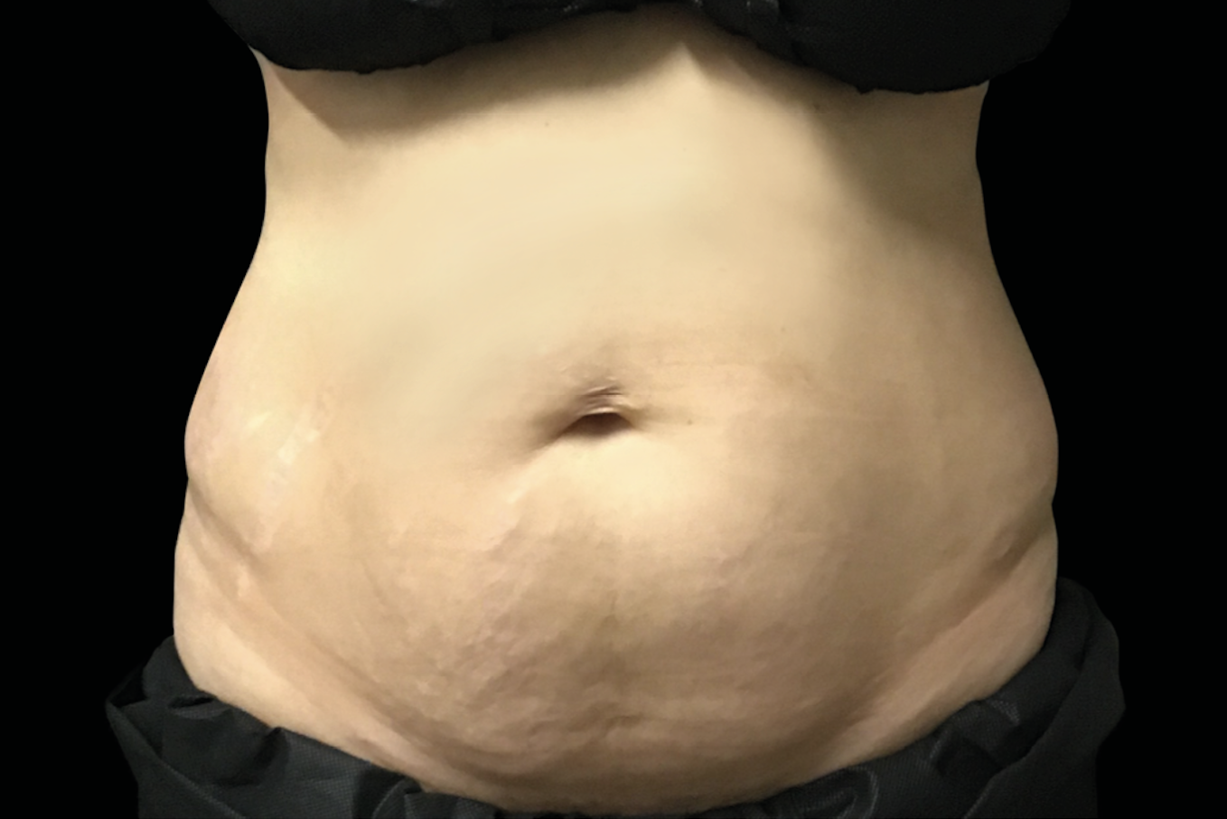 Before EMSELLA treatment