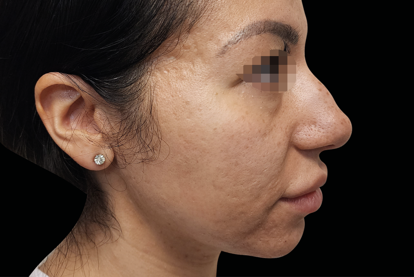 After EXION treatment