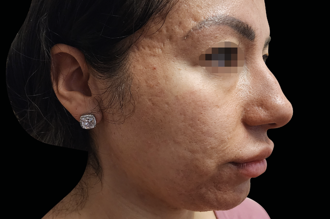Before EXION treatment