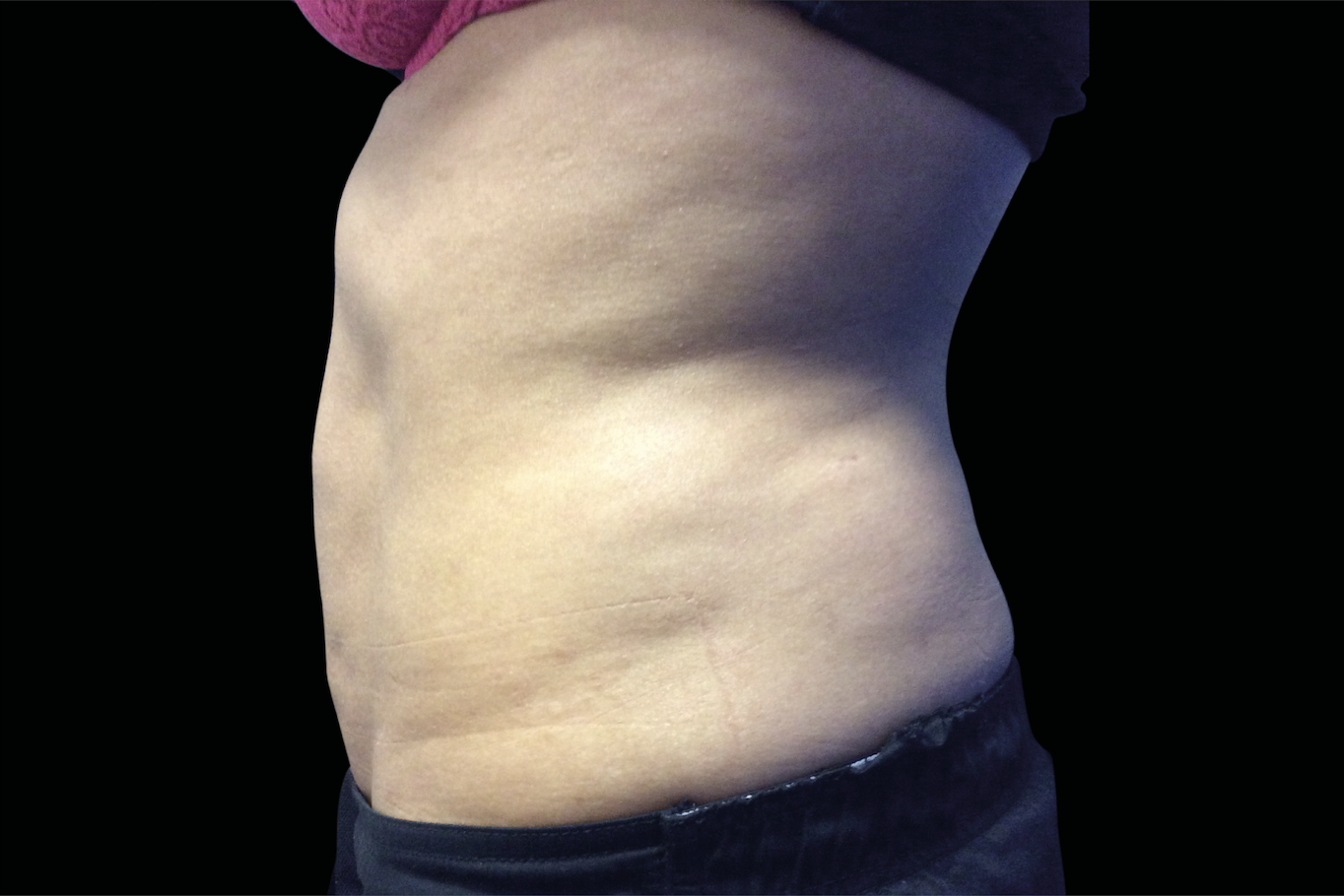 After Invisa-RED treatment