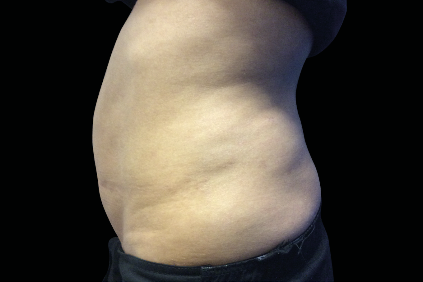 Before Invisa-RED treatment